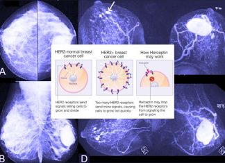 Herceptin : The two-in-one treatment keeps women’s breast cancers at bay
