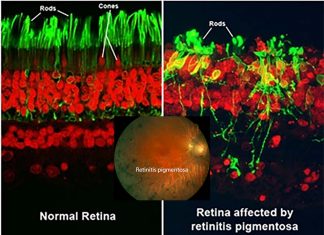 Immune system can slow retinitis pigmentosa disease
