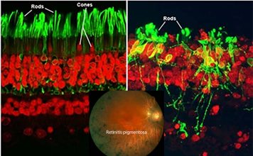 Immune system can slow retinitis pigmentosa disease