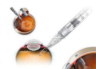 Macular degeneration : new hope with a drug reservoir implant