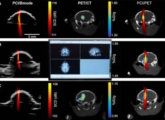 New focused ultrasound method restores dopaminergic pathway in brain at Parkinson’s early stages