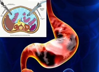 New treatment for stomach cancer with aerosol therapy