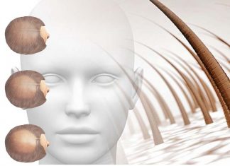 Novel ways to combat pattern hair loss in men and women