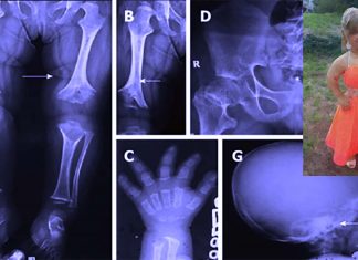 A groundbreaking drug has boosted growth rates in children with common type of dwarfism