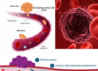 Research team has demonstrated the ability to detect and kill circulating tumor cells (CTCs) in the blood using a noninvasive device called Cytophone