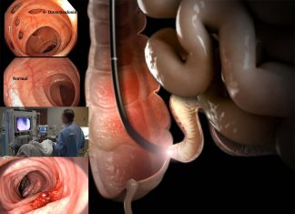 Colon cancer : researchers have determined that deep sedation does not improve the colonoscopy quality