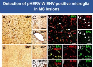 The human endogenous retrovirus type W (pHERV-W) was found to be a major contributor to nerve damage in multiple sclerosis