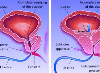 Researchers identified a genetic signature that signals enlarged prostate tissue