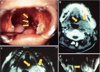Researchers have found a way to customize treatment for a type of head and neck cancer associated with HPV infection