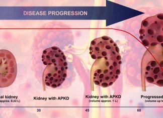Researchers have found a compound to treat autosomal dominant polycystic kidney disease (ADPKD)