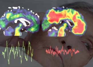 Sleep disruptions during middle age may be a potential biomarker for developing Alzheimer’s disease later in life