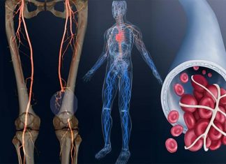 Doctors must be on alert about signs and symptoms of deep vein thrombosis (DVT) because are nonspecific and often difficult to diagnose