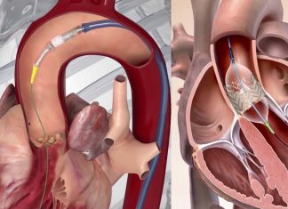 The catheter-based valve replacement procedures is safe for patients with common heart defect