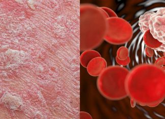 Anti-inflammatory biologic therapies used to treat psoriasis reduce coronary inflammation
