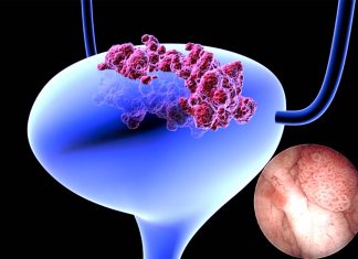 Bladder cancer could soon be predicted with a machine learning model (ML)