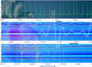Electrocardiomatrix : an accurate method to determine whether a stroke survivor had an Afib
