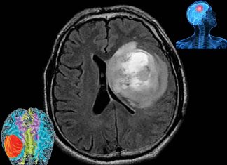Glioblastoma : shape-shifting ability could help explain why these cancer cells are so difficult to kill with drugs