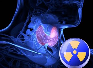 Hyperthyroidism: Researchers found that radioactive iodine (RAI) treatment increase risk of cancer death