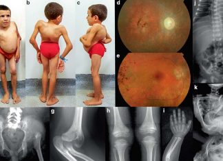 Three unrelated families on three continents had children with severe multi-organ syndrome