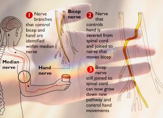 Nerve transfer surgery : restore arm function in paralysed patients