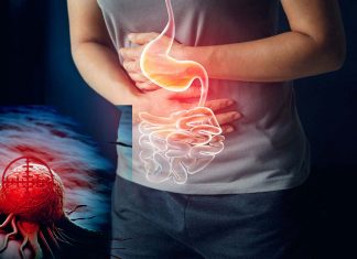 Stomach cancer: researchers have discovered that cells with normal appearance can cover cancer