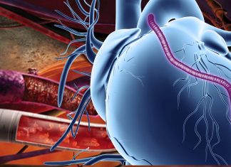 Vascular graft can improves the lives of people with coronary artery disease and congenital cardiovascular defects