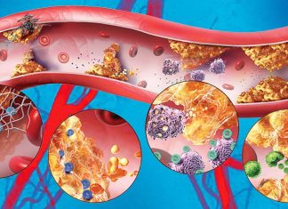Scientists has identified a cellular connection between diabetes and blood vessel narrowing