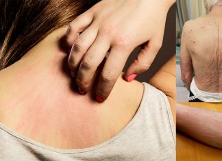 Scientists identify potential approach to chronic itch problem