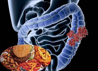Researchers unveils a correlation between inflammatory and antioxidant diets and the risk of developing colorectal – breast cancer
