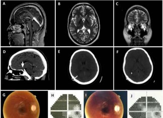 Women with idiopathic intracranial hypertension (IIH) are at twice the risk of heart conditions and stroke