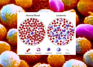 Leukemia : scientists killed the cancer hyperactivating the garbage disposal systems of leukemia cells