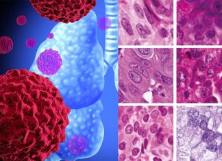 Researchers have identified markers that can distinguish between major subtypes of lung cancer