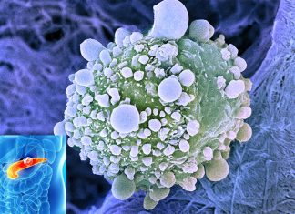 Pancreatic cancer : researchers have found a chemical compound that promotes a vigorous immune assault against the deadly cancer