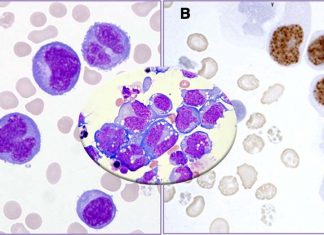 Tyro3 is highly upregulated and expressed in primary effusion lymphoma