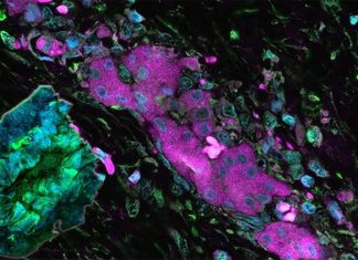 Researchers have shown the key role that a protein called Ran plays in the mobility of ovarian cancer cells