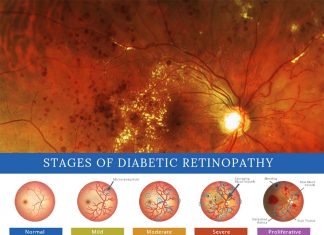 Researchers have shown that high levels of Retinol Binding Protein 3 (or RBP3) prevents the development of diabetic retinopathy