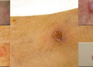 People with the highest intake of vitamin A lowered their risk of squamous cell skin cancer