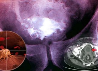 A strain of the common cold virus has been found to potentially target, infect and destroy cancer cells in patients with bladder cancer
