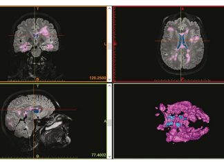 Researchers study 3-D images of MS lesions in the brain to differentiate between injuries that are likely to heal or not