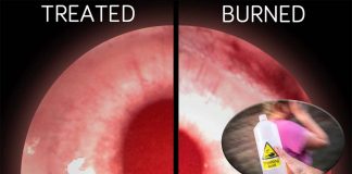 A revolutionary approach to treating chemical burns in the eye using a tissue-softening enzyme