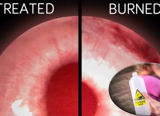 A revolutionary approach to treating chemical burns in the eye using a tissue-softening enzyme