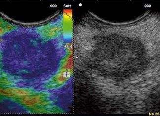Breast ultrasound elastography can quickly and accurately diagnose breast cancer