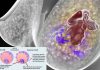 A new type of blood test for breast cancer could help avoid thousands of unnecessary surgeries