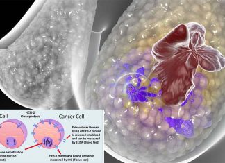 A new type of blood test for breast cancer could help avoid thousands of unnecessary surgeries