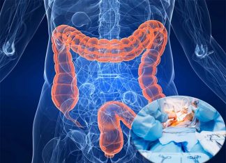 Bowel preparation did not reduce surgical site infections