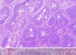 New hope for Castleman disease