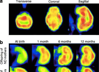 Alzheimer’s disease : high maternal fat consumption during gestation protects offspring against changes in the brain