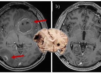 Melanoma brain metastasis occurs when tumor cells hijack an inflammatory pathway in the brain