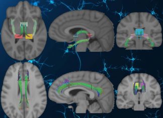 Alterations in white matter may affect how patients respond to non-invasive electrical brain stimulation