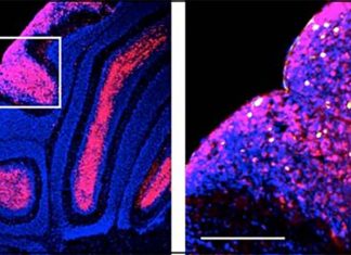 Researchers have discovered potential new treatment strategies for recurrent Sonic Hedgehog Medulloblastoma